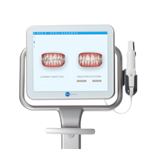 Invisalign Results